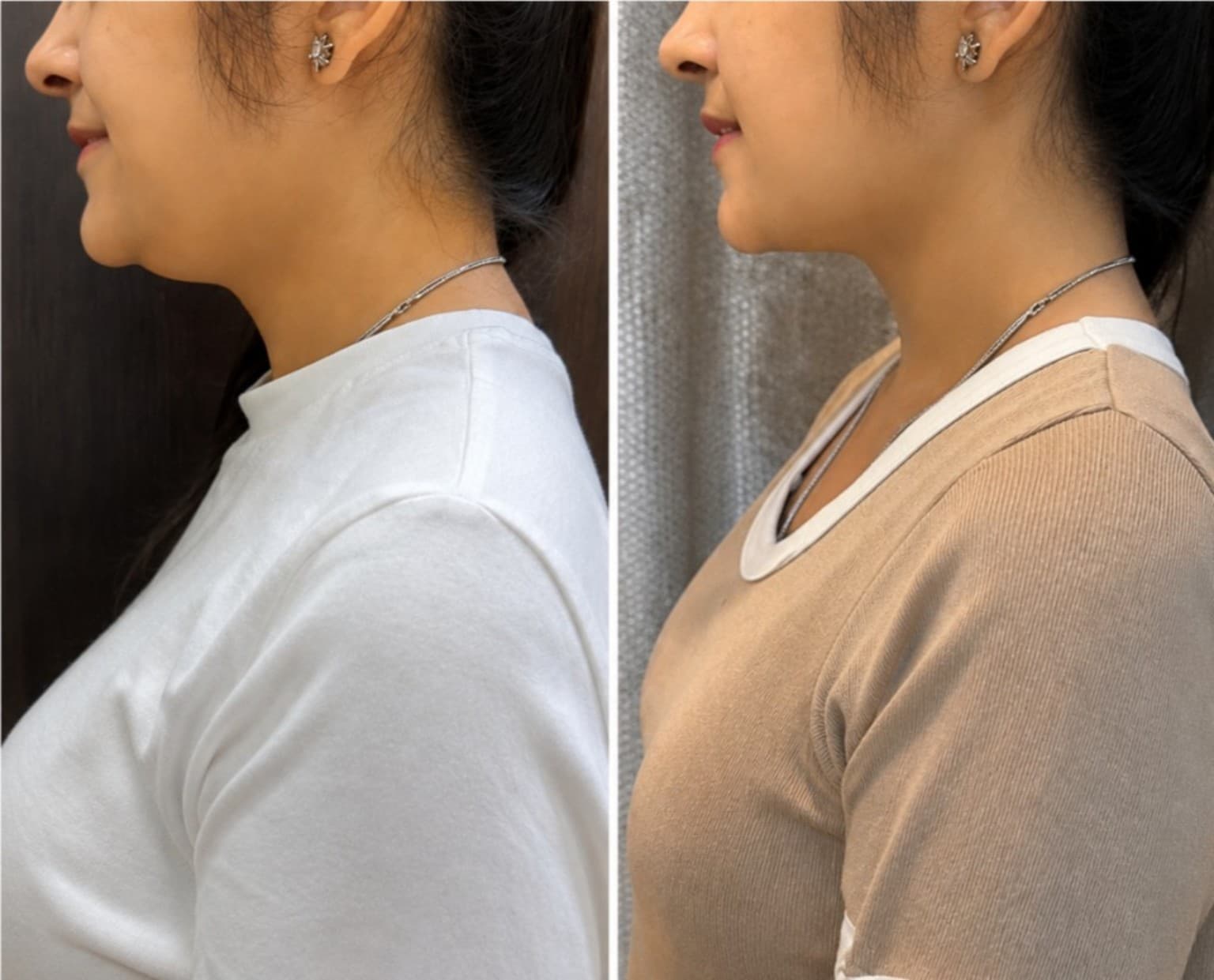 Profile and jawline before and after — sculpted contour